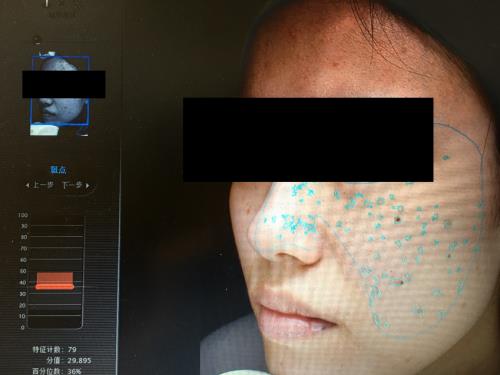 Which skin detector is stronger? Visia, Meitu Yishu, A-one measured